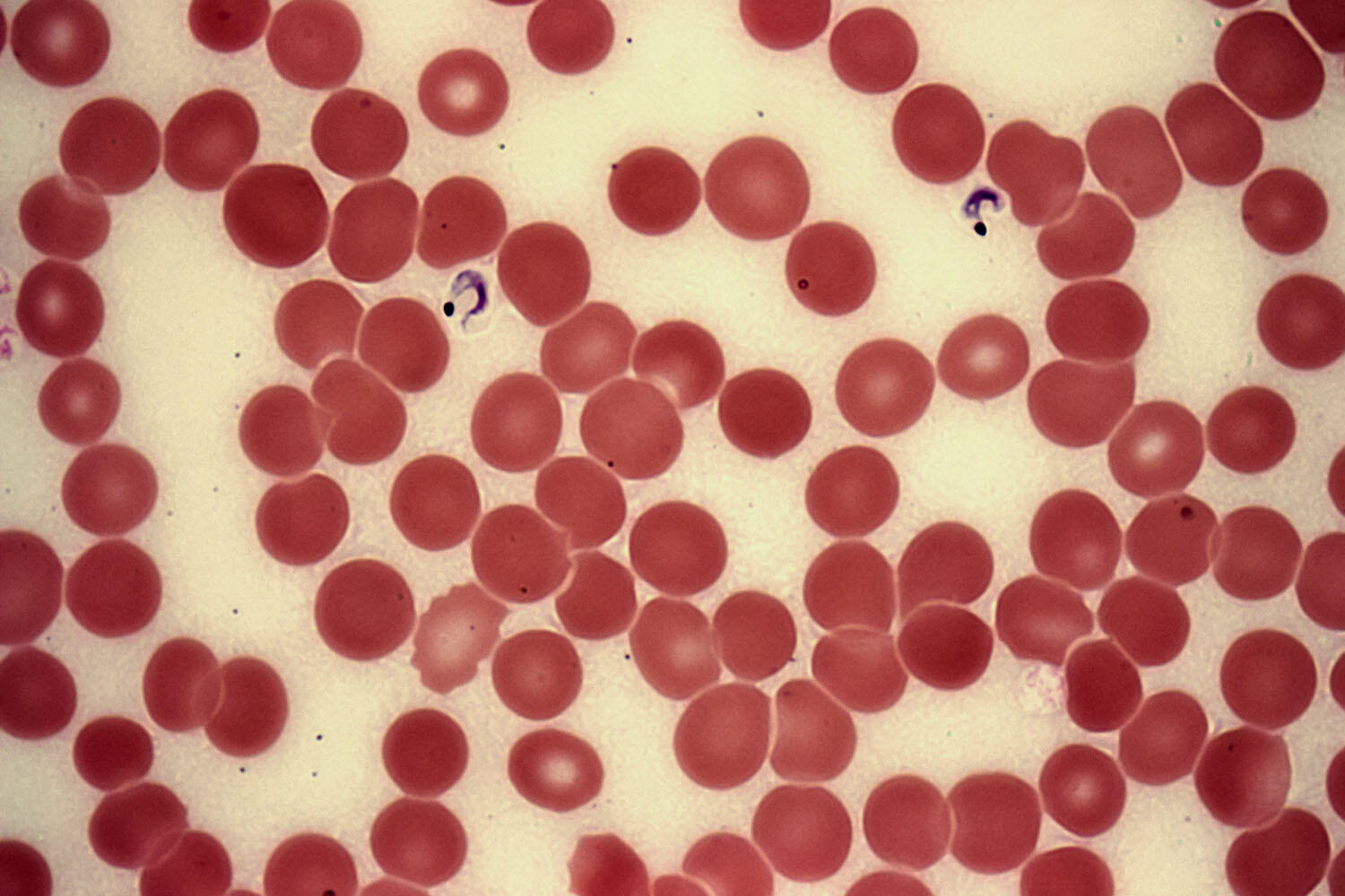 T. cruzi, the parasitic organism that causes Chagas disease, seen here in purple amid red blood cells. (Photo by Marc Perkins.) T. cruzi, the parasitic organism that causes Chagas disease, seen here in purple amid red blood cells. (Photo by Marc Perkins.)